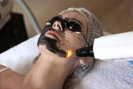 carbon peel kozmetikai kezelés Carbon Peel kozmetikai kezelés